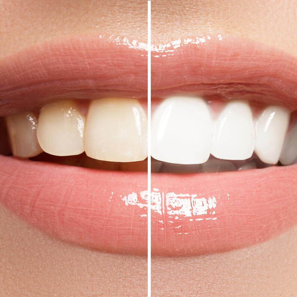 Blanqueamiento dental Dentisalud total